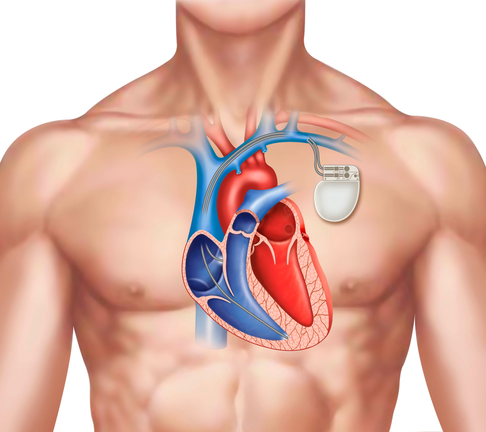 illustration of a human figure with a pacemaker on the left side of the chest